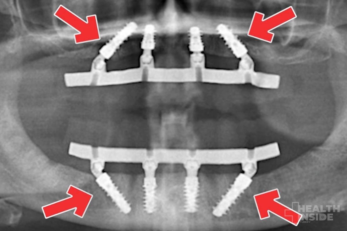 all-on-4-dental-implants-in-turkey-treatments-in-turkey-example