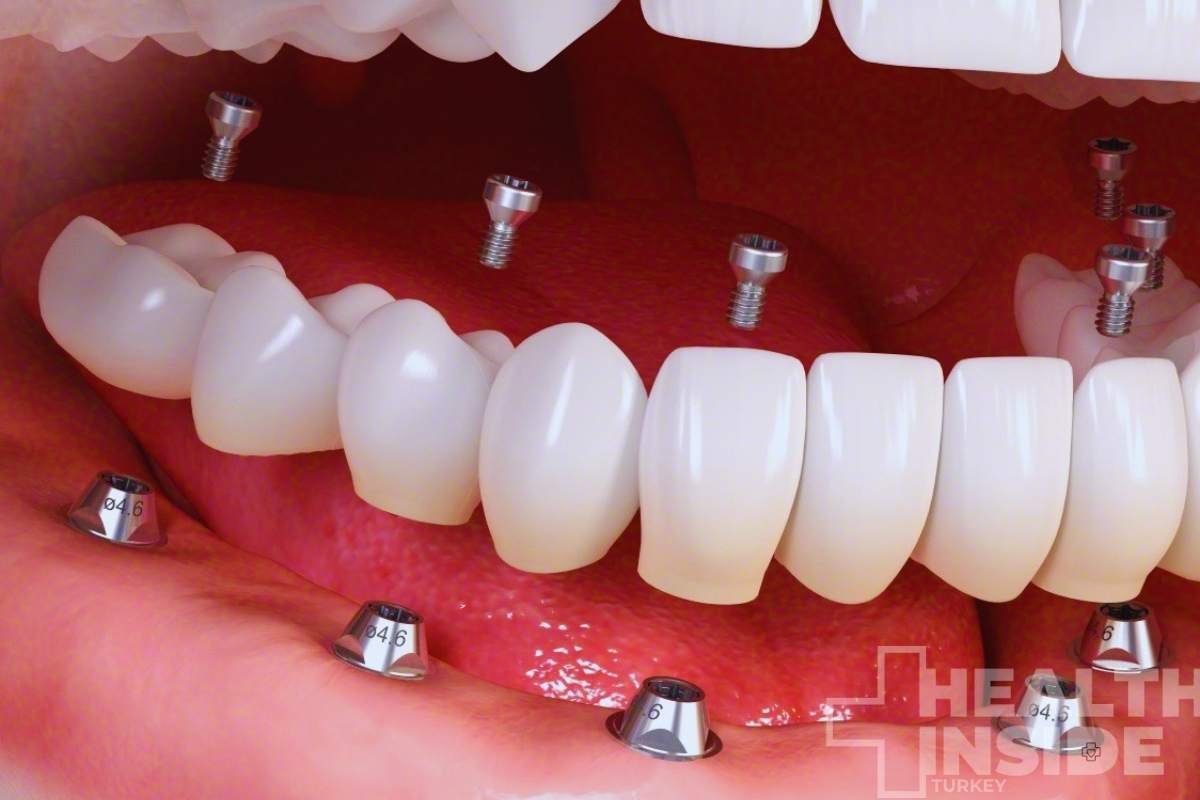 all-on-6-dental-implants-in-turkey-treatments-in-turkey-example